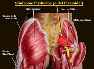 Sindrome del Piriforme a Brescia